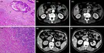 Preoperative prediction of colorectal liver metastases aggressiveness using pathomics