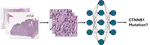 Predicting CTNNB1 S45F Mutation in Desmoid Tumors from H&E-Stained Histopathology Images